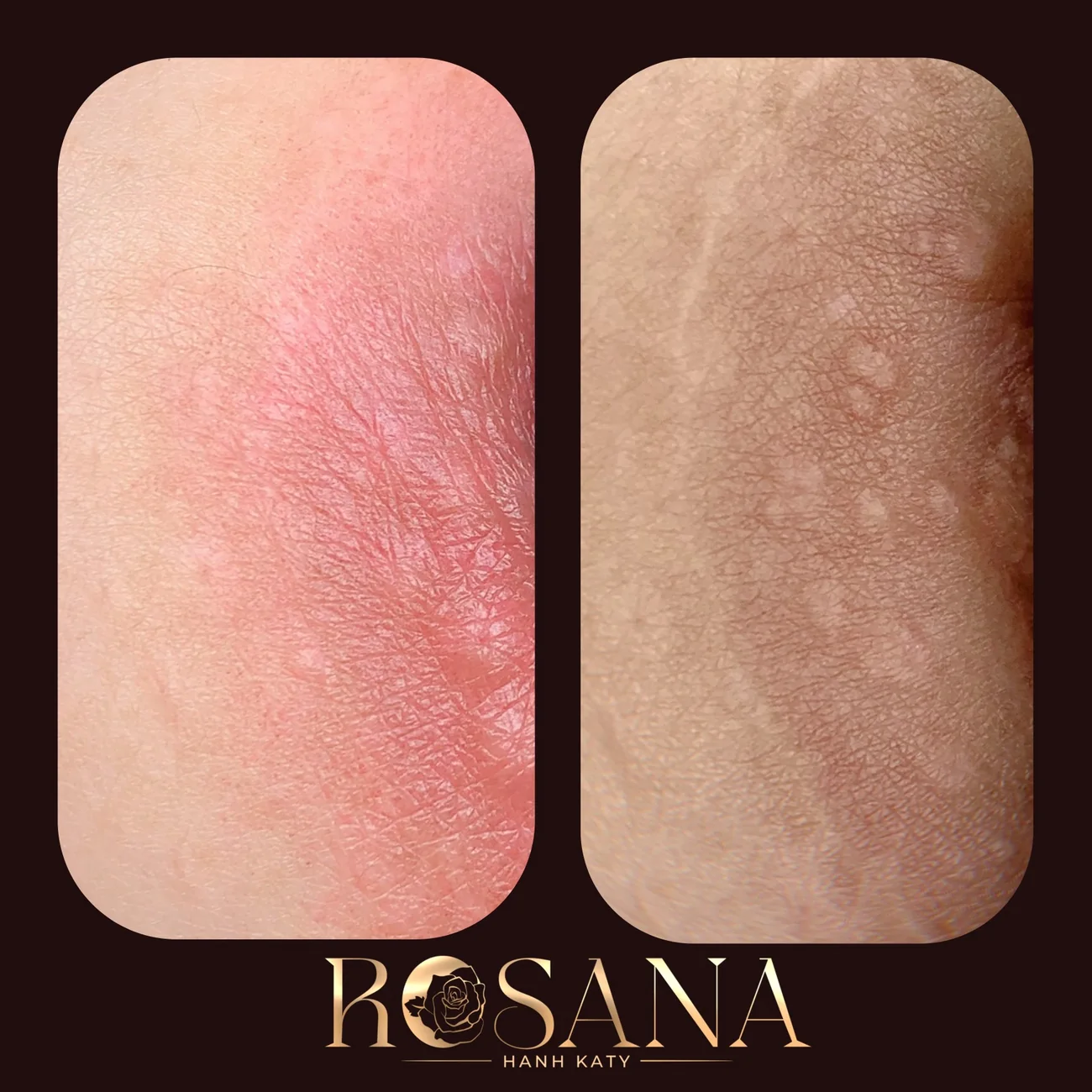 Trước khi làm và sau bong với Rosana